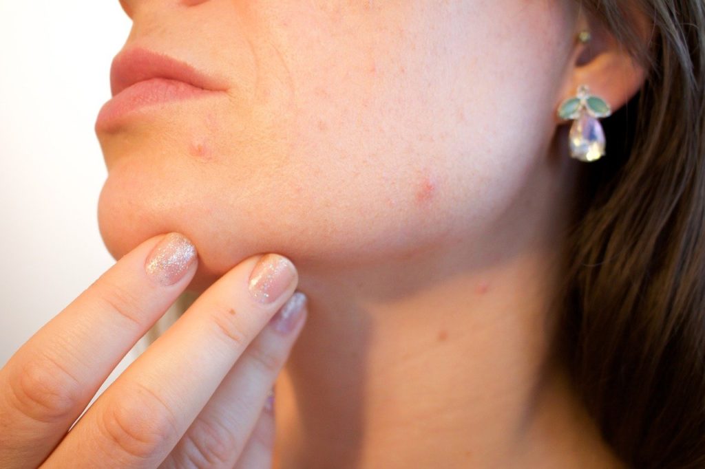 Acne Pores Skin Pimple Female - Kjerstin_Michaela / Pixabay