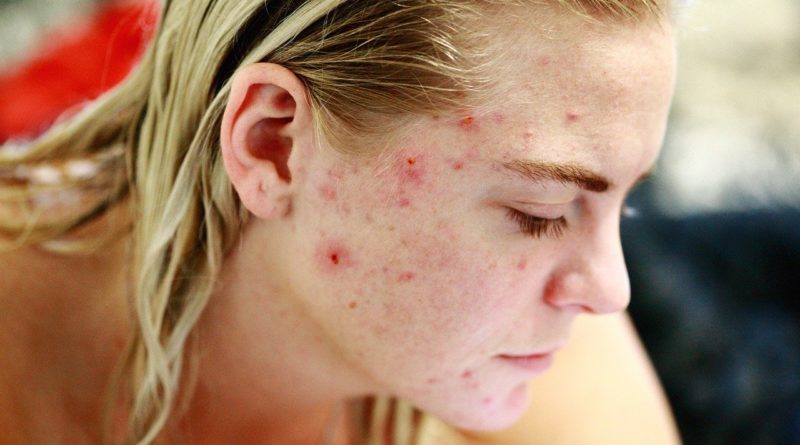 Struggle Acne Self Love Skin Face  - SharonMcCutcheon / Pixabay
